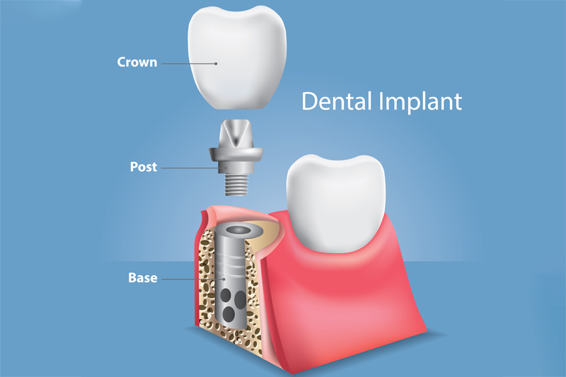 Implantacja – korony na implantach opis implantu