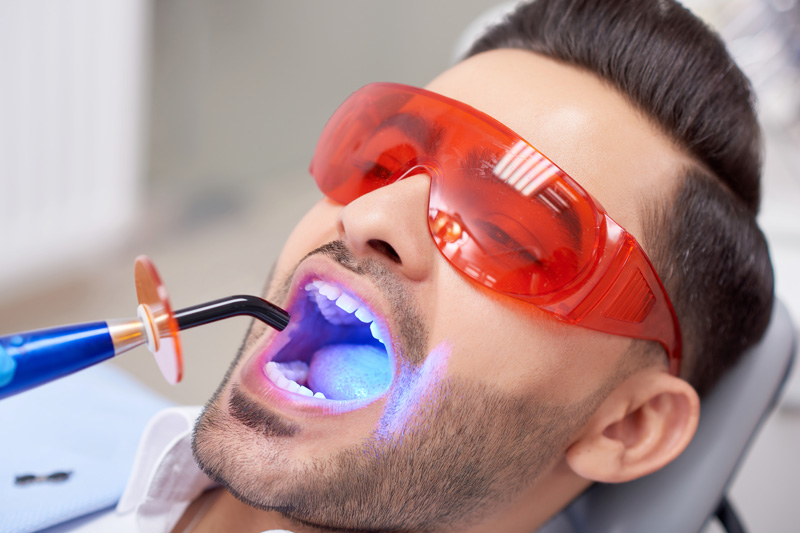 usuwanie przebarwień zębów naświetlanie