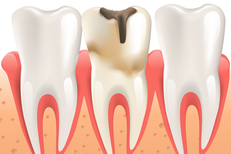 stomatologia zachowawcza wizyta kontrolna grafika próchnica zębów